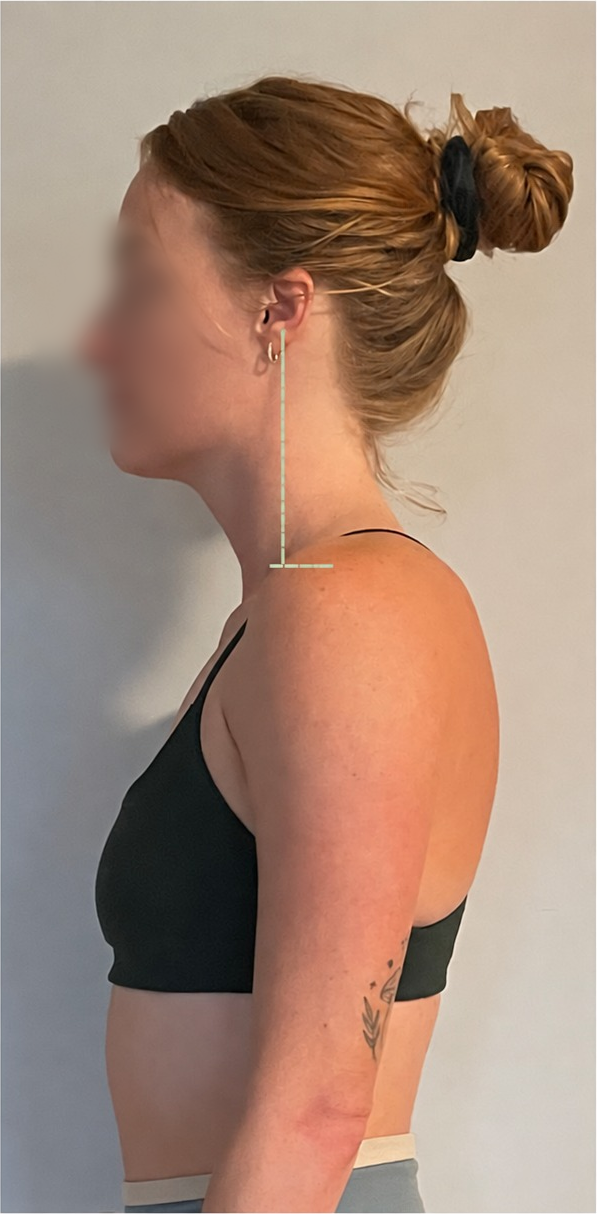 Post-Rolfing Cervical Alignment Result
