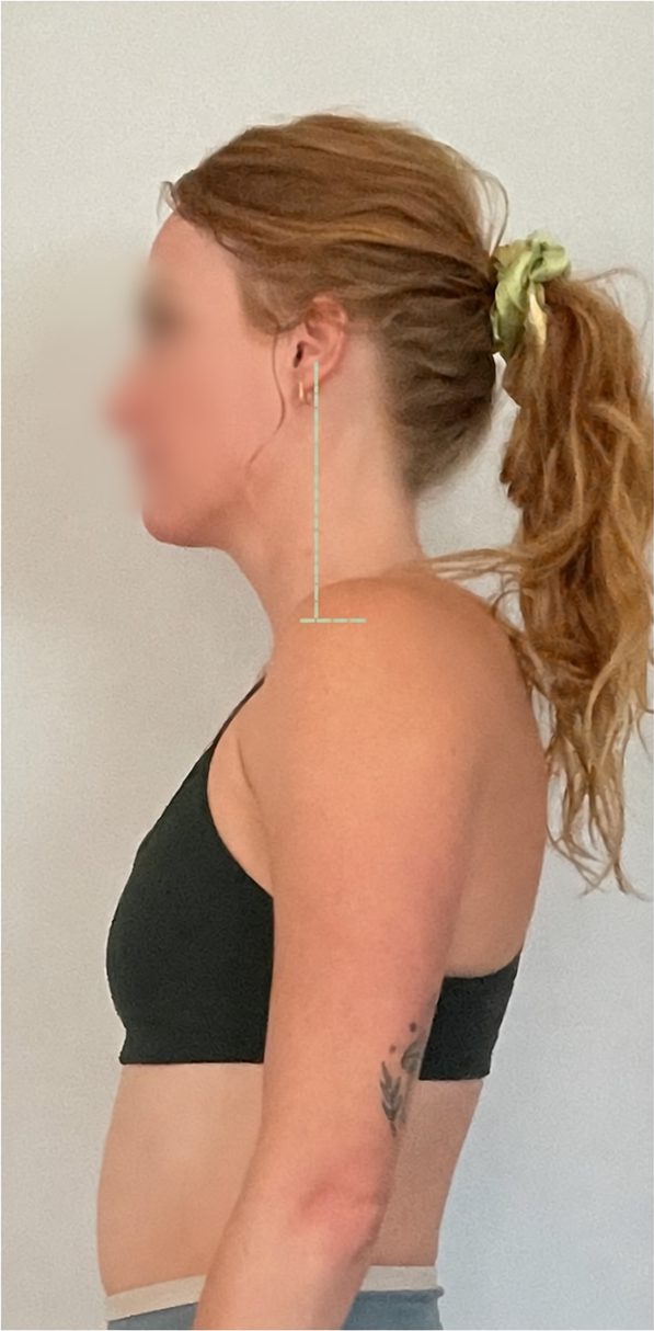 Pre-Rolfing Forward Head Carriage